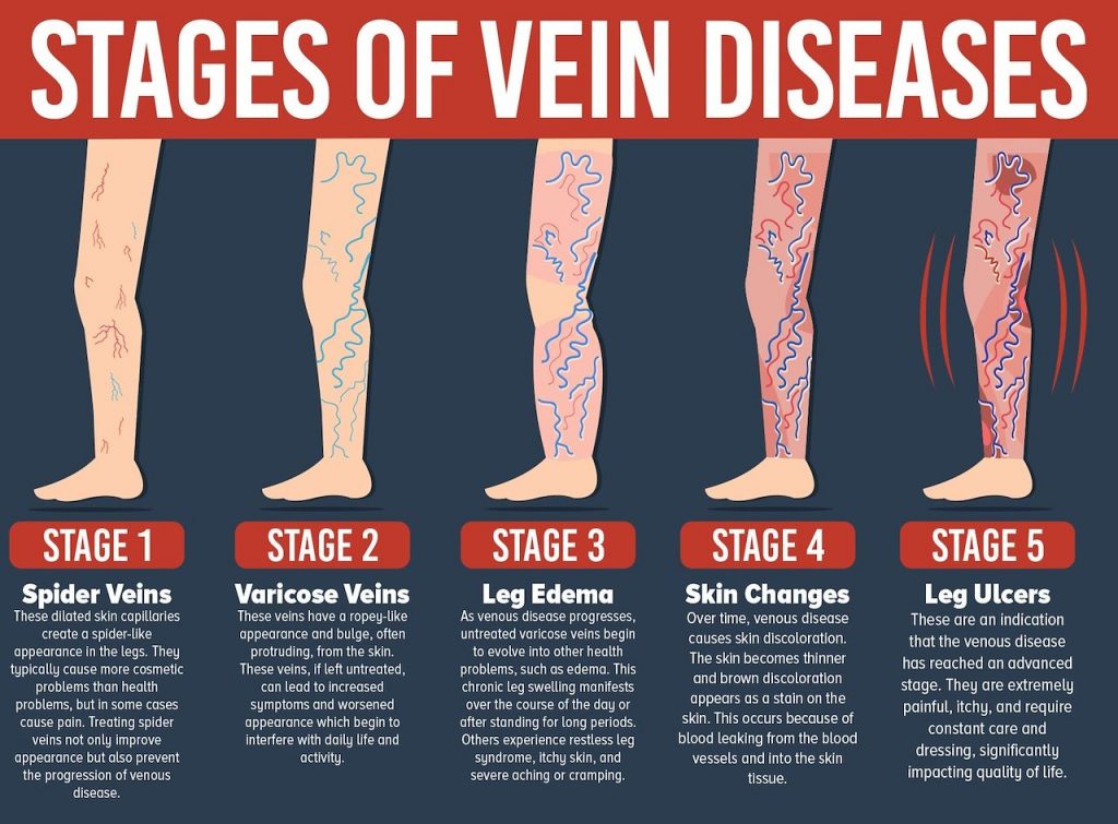 Causes and Prevention of Varicose and Spider Veins